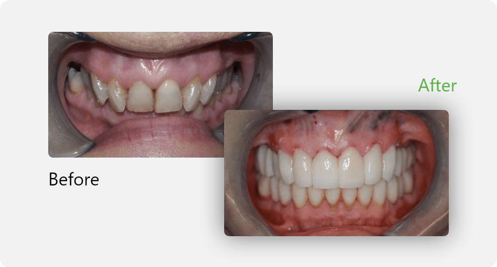 Smile Gallery | Before & After | Edmonton General Dentist | Sana Dental | Edmonton, AB