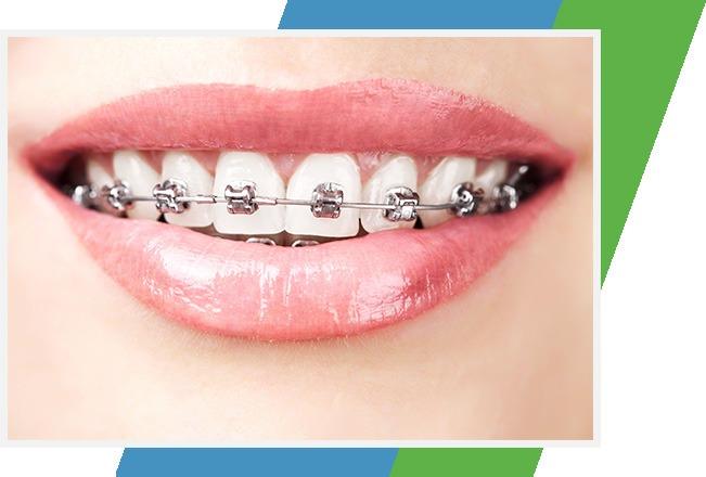 Braces Treatment | Sana Dental | North Edmonton Dentist | Edmonton, AB