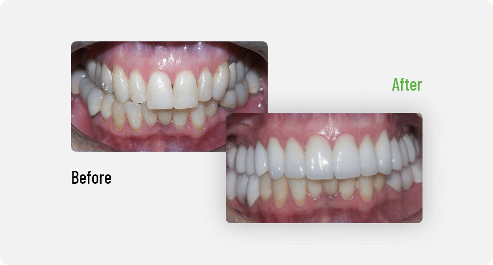 Cheryl Before | Sana Dental | General & Family Dentist | North Edmonton