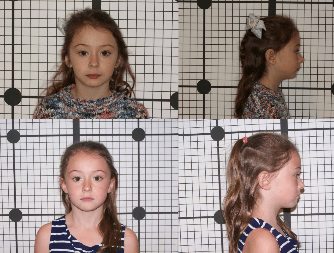 Child Epgigenetic Orthodontics | Sana Dental | North Edmonton Dentist | Edmonton, AB