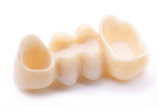 Dental Bridges | Sana Dental | General & Family Dentist | North Edmonton