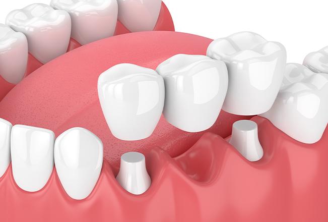 Dental Bridges | Sana Dental | General & Family Dentist | North Edmonton