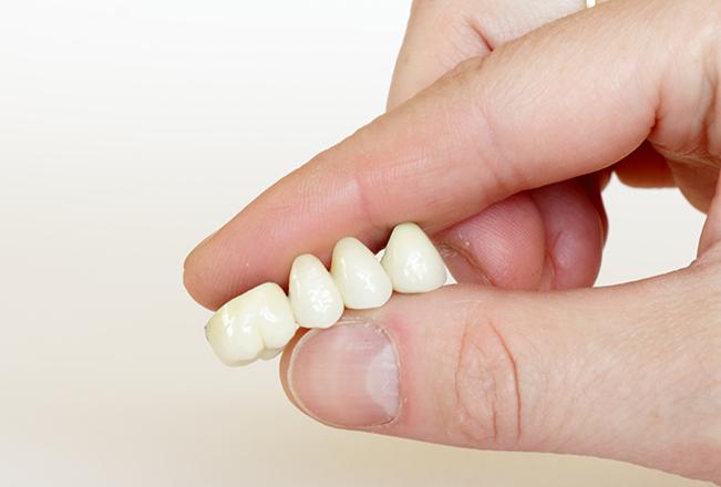 Dental Bridges | Sana Dental | General & Family Dentist | North Edmonton