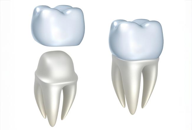 Dental Crowns | Sana Dental | General & Family Dentist | North Edmonton