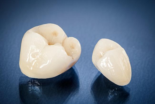 Dental Crowns | Sana Dental | General & Family Dentist | North Edmonton