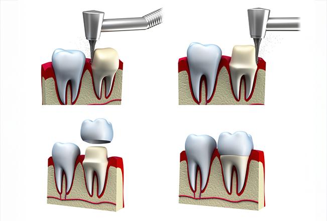 Dental Crowns | Sana Dental | General & Family Dentist | North Edmonton