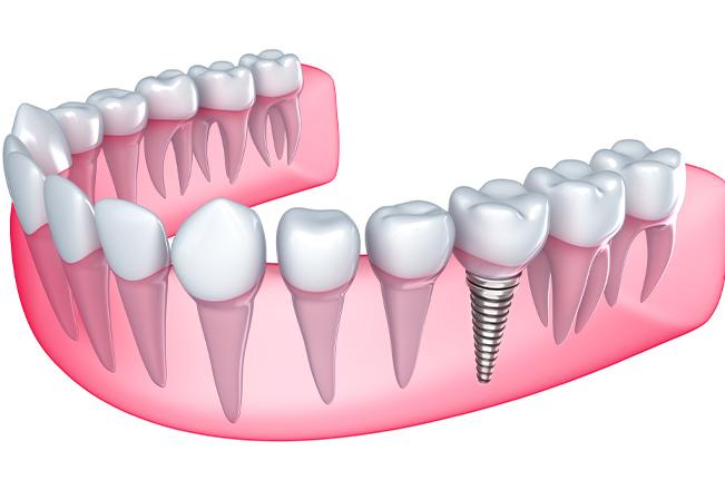 Dental Implants | Sana Dental | General & Family Dentist | North Edmonton