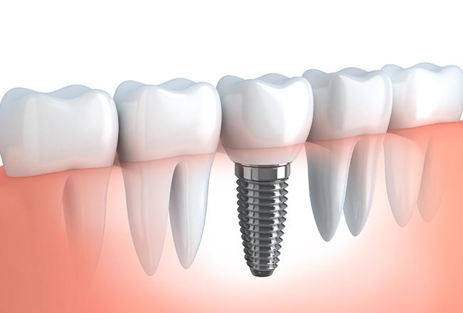 Dental Implants | Sana Dental | General & Family Dentist | North Edmonton