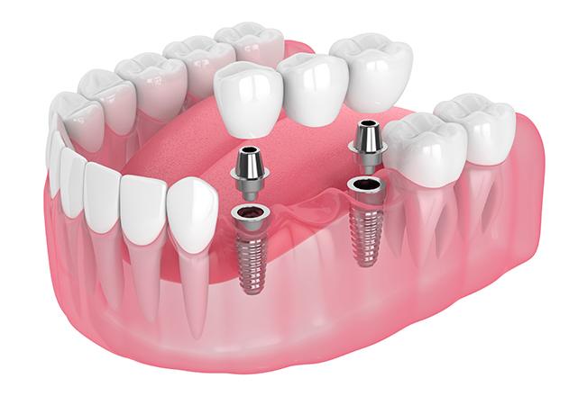 Dental Implants | Sana Dental | General & Family Dentist | North Edmonton