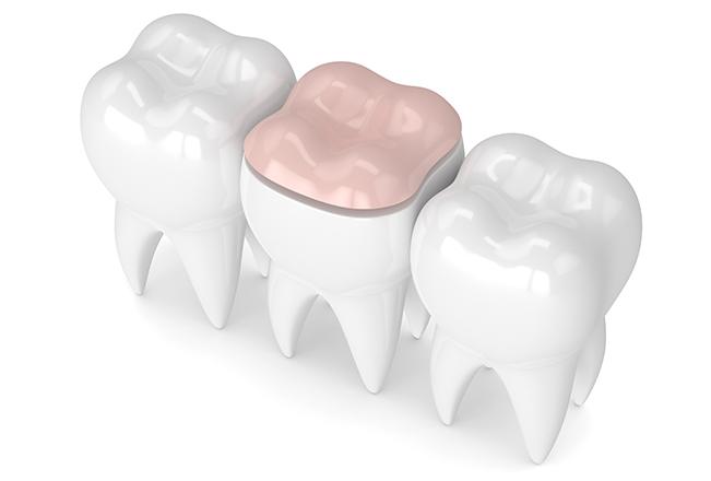 Dental Inlays & Onlays | Sana Dental | General & Family Dentist | North Edmonton