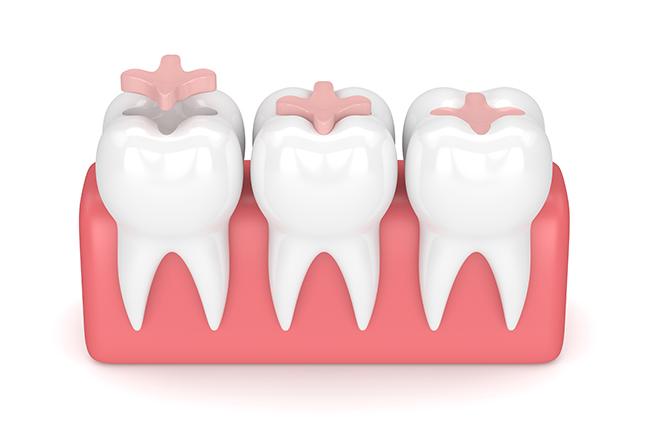 Dental Inlays & Onlays | Sana Dental | General & Family Dentist | North Edmonton