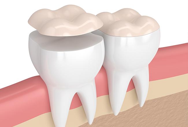 Dental Inlays & Onlays | Sana Dental | General & Family Dentist | North Edmonton