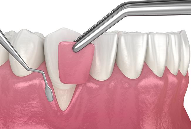 Gum Contouring | Sana Dental | General & Family Dentist | North Edmonton