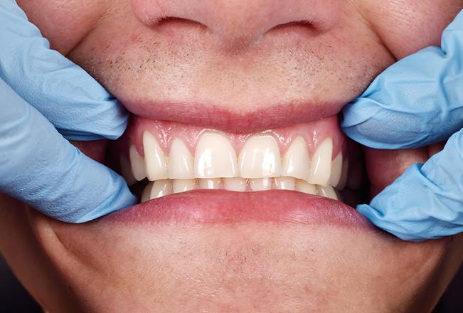 Gum Contouring | Sana Dental | General & Family Dentist | North Edmonton