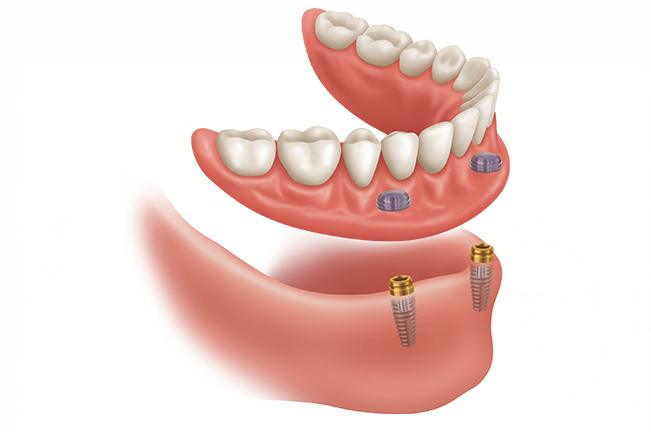 Implant Retained Dentures | Sana Dental | General & Family Dentist | North Edmonton