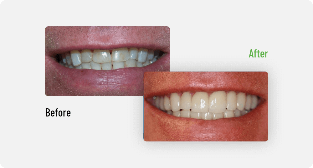Ken Before After images | Sana Dental | General & Family Dentist | North Edmonton