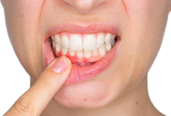 Periodontal Disease | Sana Dental | General & Family Dentist | North Edmonton