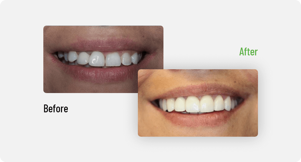 Lisa Patient Smile Gallery | Sana Dental | General & Family Dentist | North Edmonton