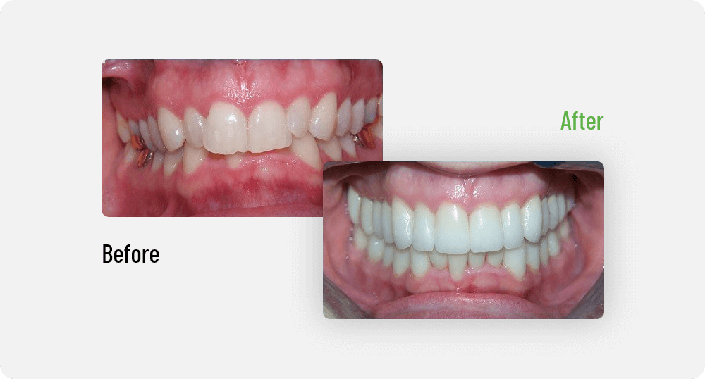 Smile Gallery Before - After | Sana Dental | General & Family Dentist | North Edmonton