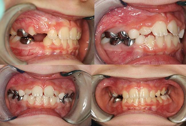 MyoBrace for Children | Sana Dental | General & Family Dentist | North Edmonton