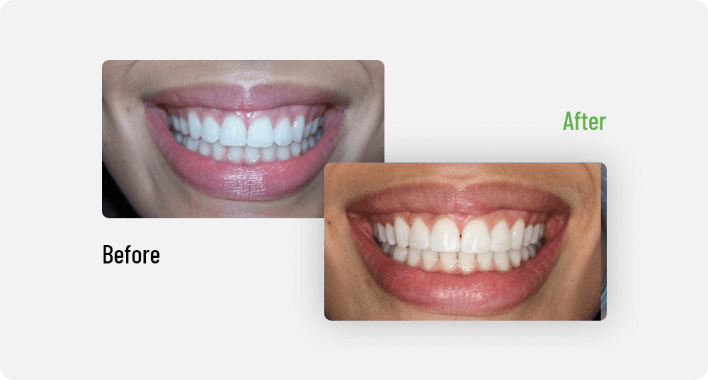 Paula Patient Treatment | Sana Dental | General & Family Dentist | North Edmonton