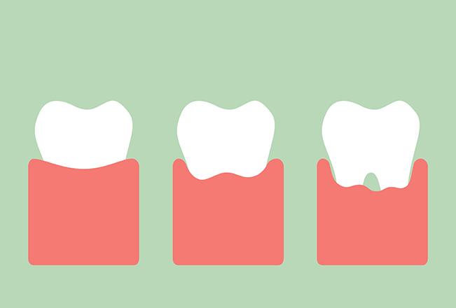 Periodontal Disease | Sana Dental | General & Family Dentist | North Edmonton