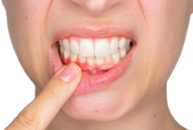 Periodontal Disease | Sana Dental | General & Family Dentist | North Edmonton