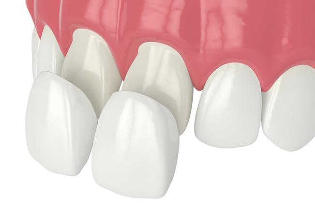 Porcelain Veneers | Sana Dental | General & Family Dentist | North Edmonton