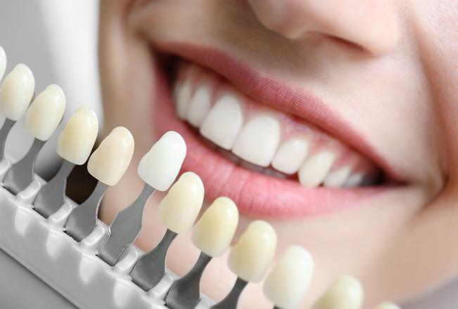 Porcelain Veneers | Sana Dental | General & Family Dentist | North Edmonton