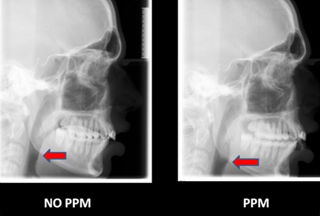 PPM Mouthguard | Sana Dental | General & Family Dentist | North Edmonton