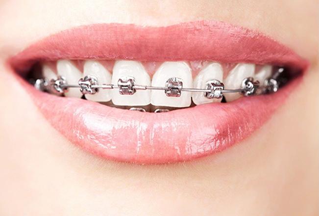 Edmonton Traditional Braces | Sana Dental | General & Family Dentist | North Edmonton