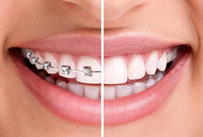 Edmonton Traditional Braces | Sana Dental | General & Family Dentist | North Edmonton
