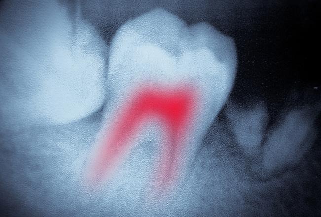 Root Canal Therapy | Sana Dental | General & Family Dentist | North Edmonton