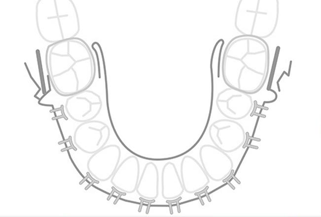 ARA Controlled Arch Sleep Device | Sana Dental | General & Family Dentist | North Edmonton