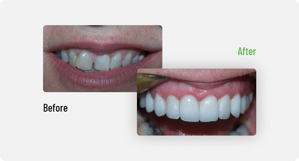 Susan Before | Sana Dental | General & Family Dentist | North Edmonton