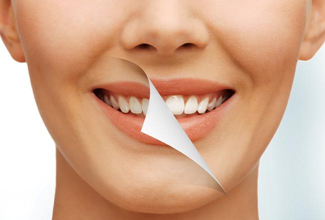 Teeth Whitening | Sana Dental | General & Family Dentist | North Edmonton