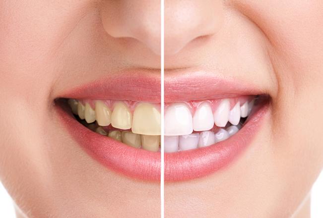 Teeth Whitening | Sana Dental | General & Family Dentist | North Edmonton