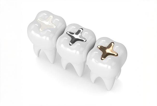 Tooth Coloured Fillings | Sana Dental | General & Family Dentist | North Edmonton
