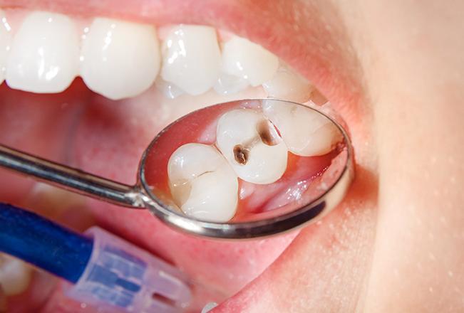 Tooth Coloured Fillings | Sana Dental | General & Family Dentist | North Edmonton