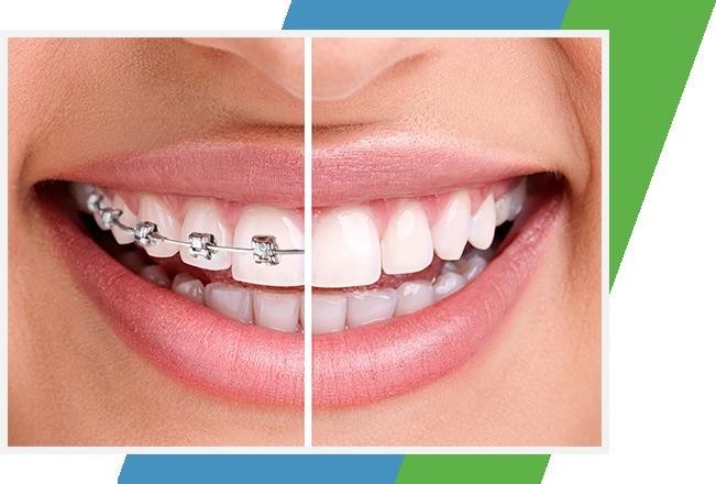 Traditional Braces Benefits | Sana Dental | North Edmonton Dentist | Edmonton, AB