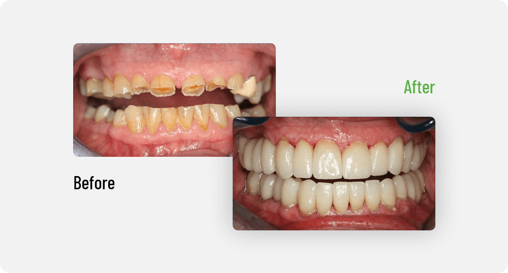 Before & After | Edmonton General Dentist | Sana Dental | Edmonton, AB