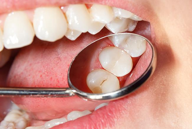 Tooth Coloured Fillings | Sana Dental | General & Family Dentist | North Edmonton