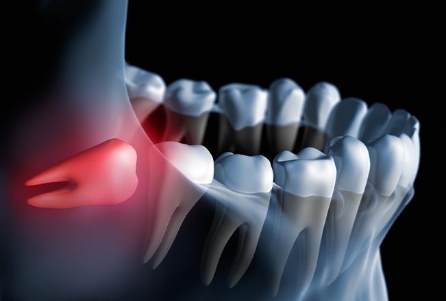 Wisdom Teeth Extraction | Sana Dental | General & Family Dentist | North Edmonton