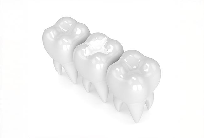 Tooth Coloured Fillings | Sana Dental | General & Family Dentist | North Edmonton
