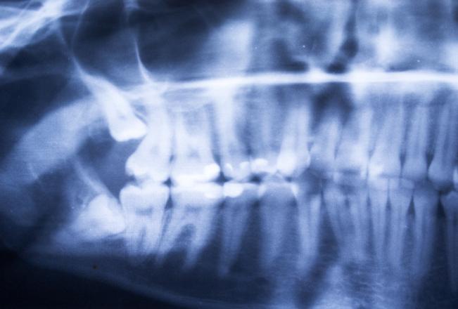 Wisdom Teeth Extraction | Sana Dental | General & Family Dentist | North Edmonton