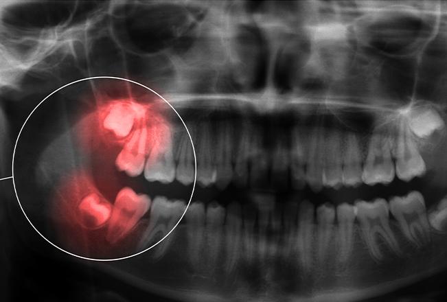 Wisdom Teeth Extraction | Sana Dental | General & Family Dentist | North Edmonton